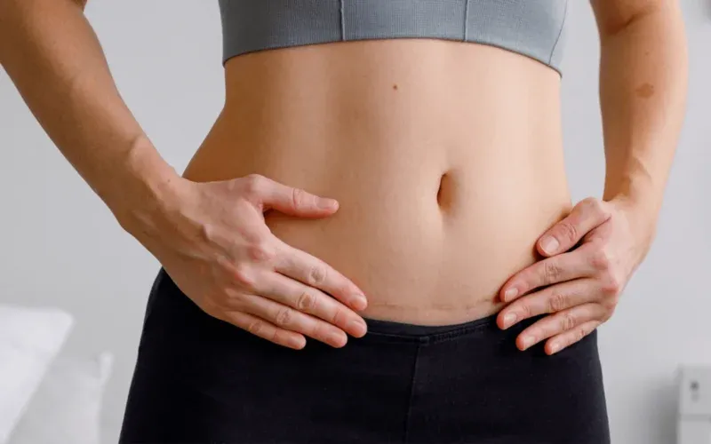 Sezaryen sonrası dikiş yerim çok kaşınıyor, bu iyileşme belirtisi mi?