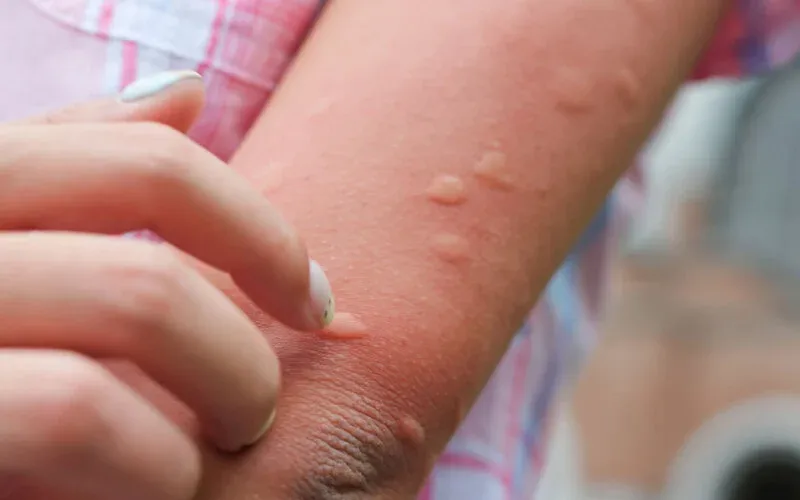 Sivrisinek ısırığına ne sürüyorsunuz, kaşıntısını ne geçiriyor?