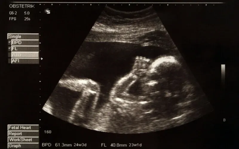 Anne karnında ters duran bebek görüntüsü nasıl fark edilir?